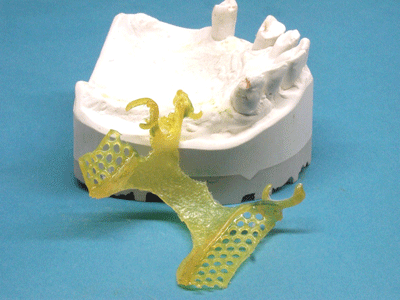 Ti-Light pattern after light curing, lifted off from model