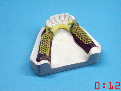 Cured Ti-Light patterns can be modified or reinforced with regular wax or Ti-Light pattern material. Ti-Light patterns remain inherently stable after curing.