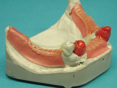 The change of color during the curing process is a key feature of Ti-Light patterns. Thus any dental curing light can be used for the curing process and the current status is visualized.